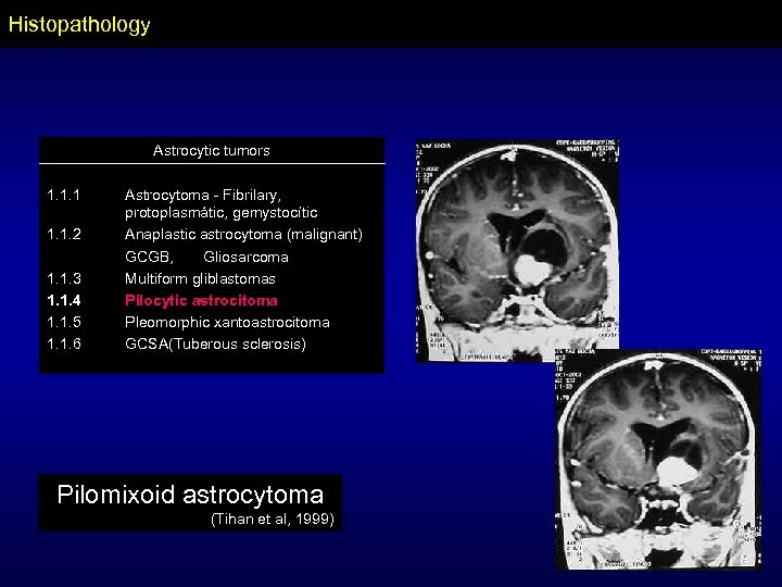 Histopathology Astrocytic tumors 1. 1. 1. 2 1. 1. 3 1. 1. 4 1.