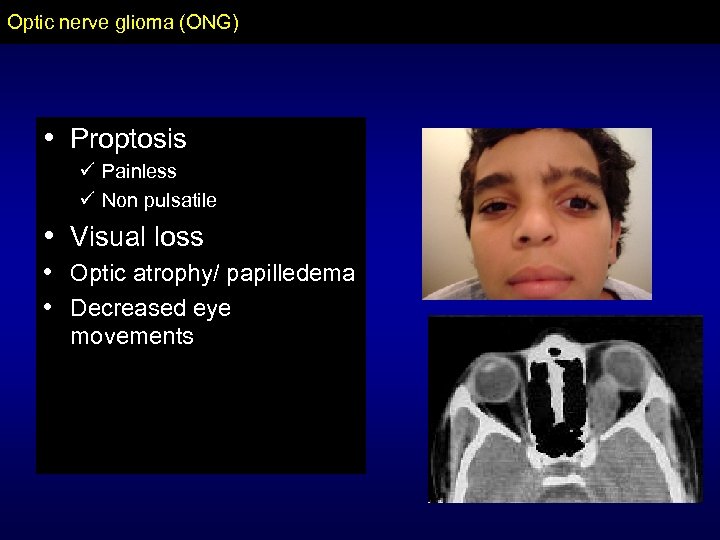 Optic nerve glioma (ONG) • Proptosis ü Painless ü Non pulsatile • Visual loss