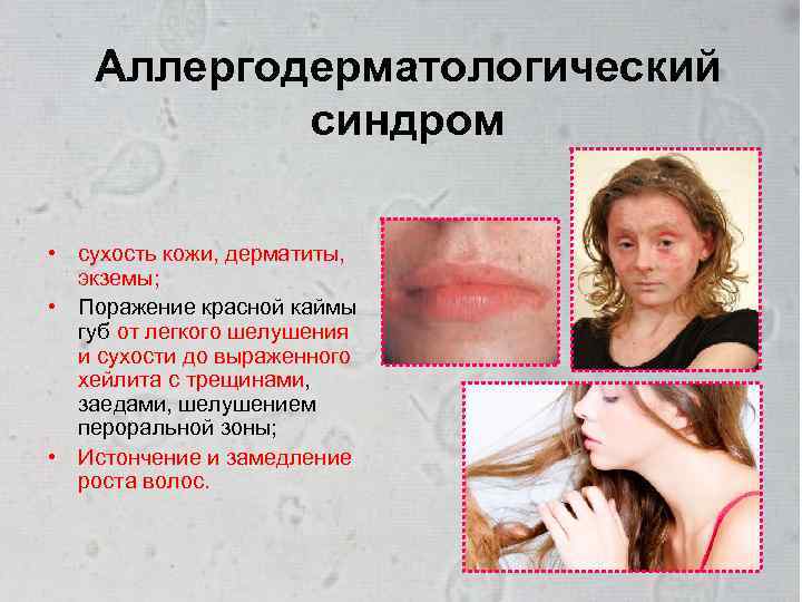 Аллергодерматологический синдром • сухость кожи, дерматиты, экземы; • Поражение красной каймы губ от легкого