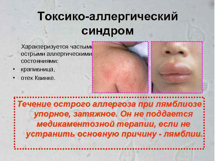 Токсико-аллергический синдром Характеризуется частыми острыми аллергическими состояниями: • крапивница, • отек Квинке. Течение острого