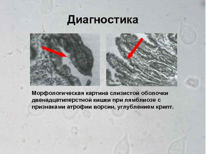 Морфологическая картина. Слизистая оболочка кишечника при лямблиозе. Атрофия ворсин, гиперплазия крипт. Морфологическая картина при лямблиозе. При лямблиозе с признаками атрофии ворсин, углублением крипт..