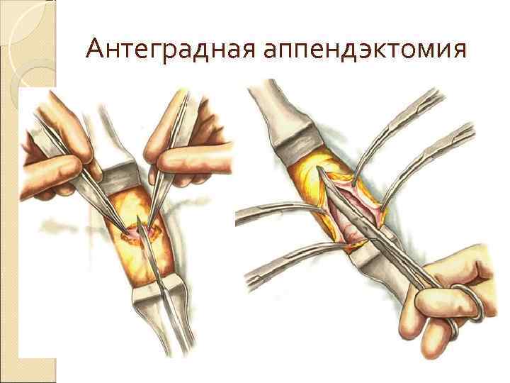 Антеградная аппендэктомия 