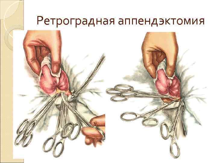 Ретроградная аппендэктомия 