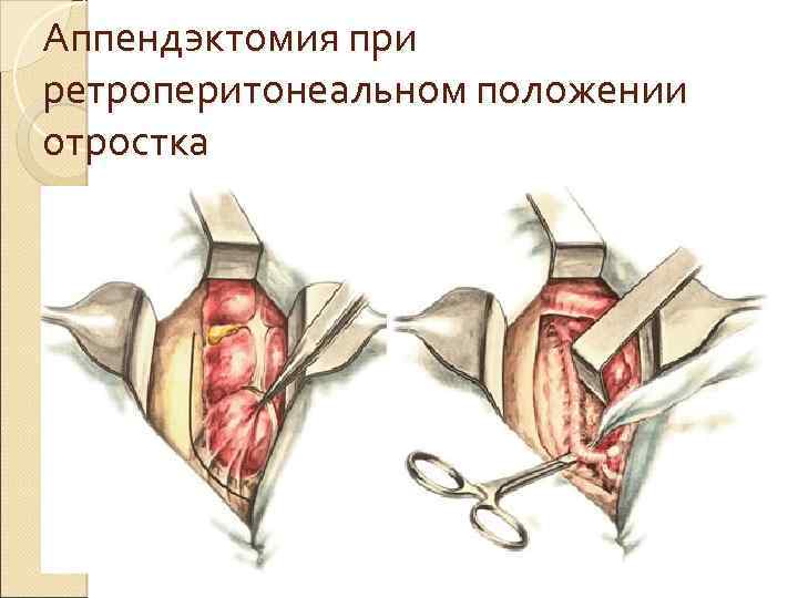 Аппендэктомия при ретроперитонеальном положении отростка 