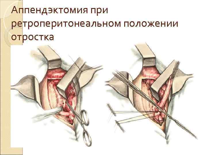 Аппендэктомия при ретроперитонеальном положении отростка 