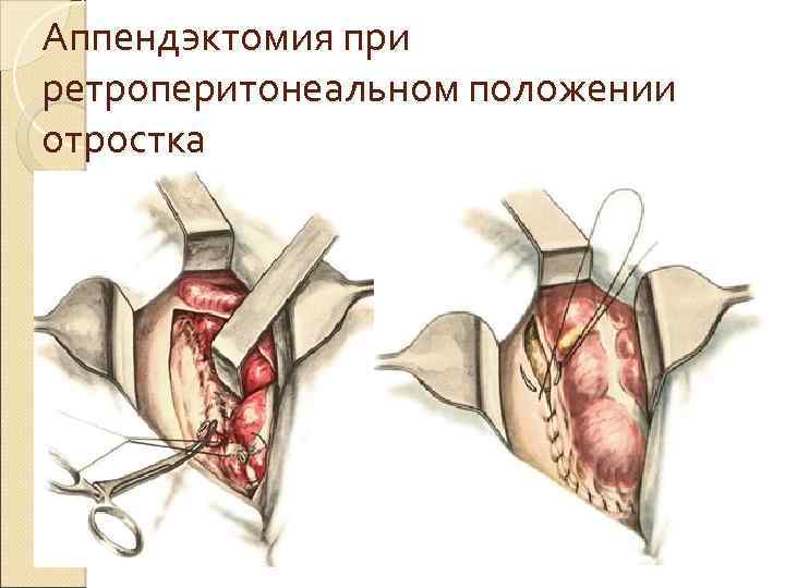 Аппендэктомия при ретроперитонеальном положении отростка 