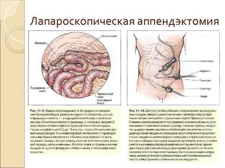 Лапароскопическая аппендэктомия 