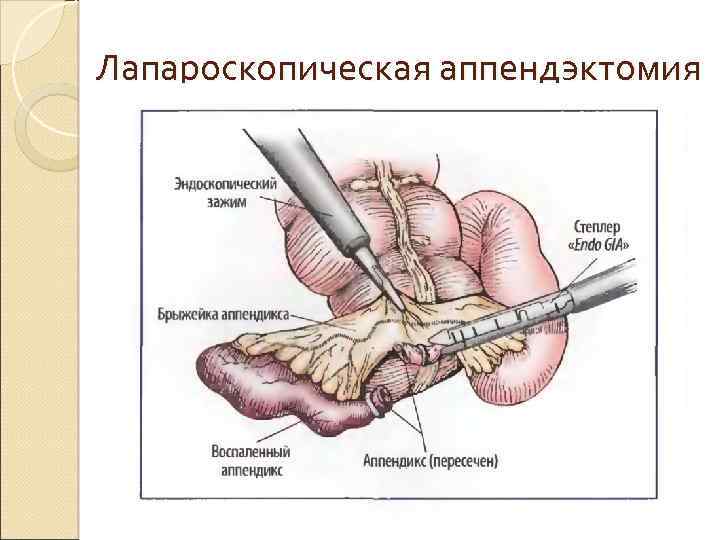 Лапароскопическая аппендэктомия 