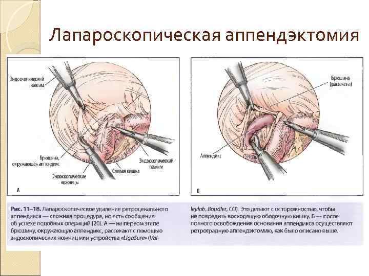 Лапароскопическая аппендэктомия 