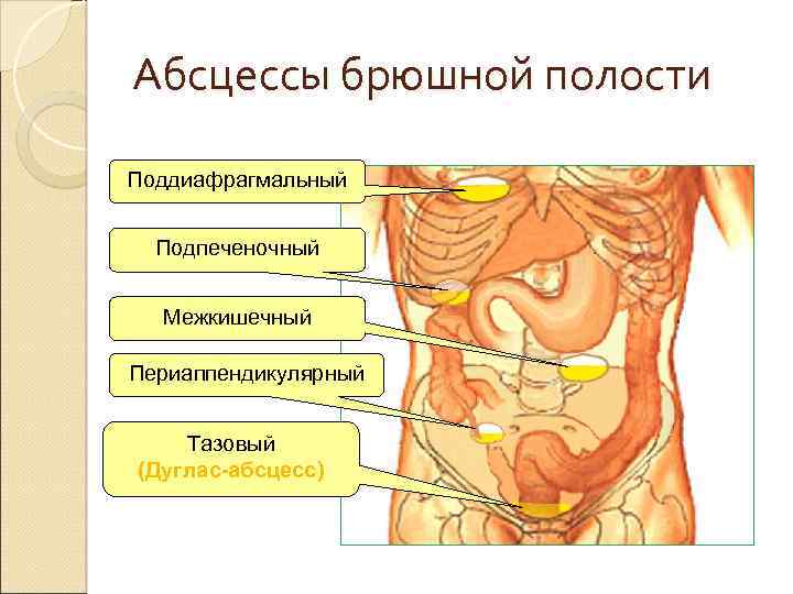 Абсцессы брюшной полости Поддиафрагмальный Подпеченочный Межкишечный Периаппендикулярный Тазовый (Дуглас-абсцесс) 