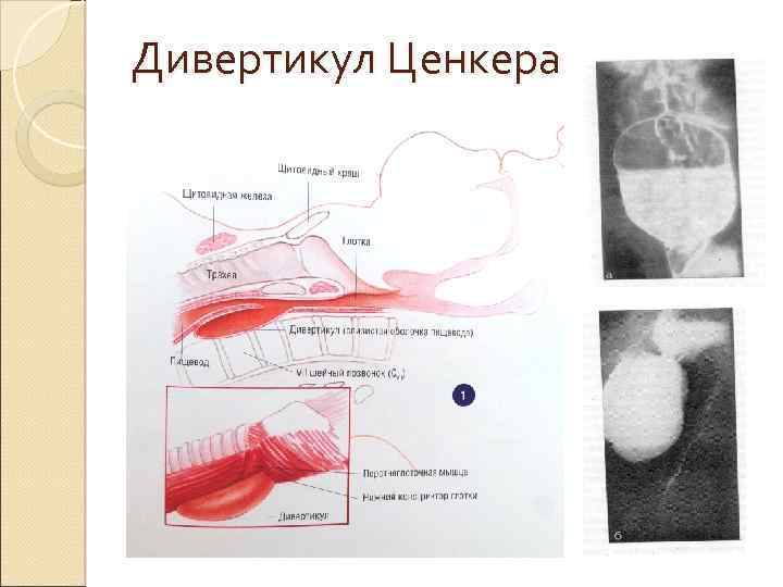 Дивертикул Ценкера 