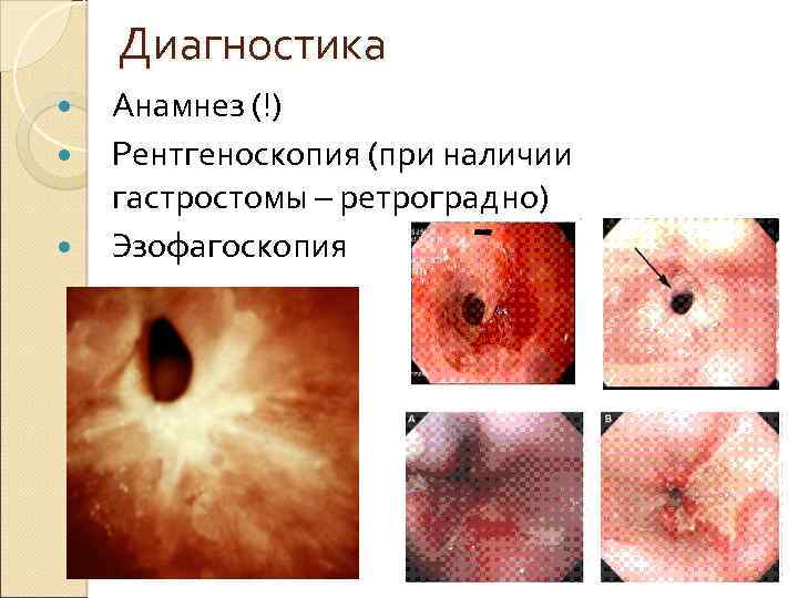 Диагностика Анамнез (!) Рентгеноскопия (при наличии гастростомы – ретроградно) Эзофагоскопия 