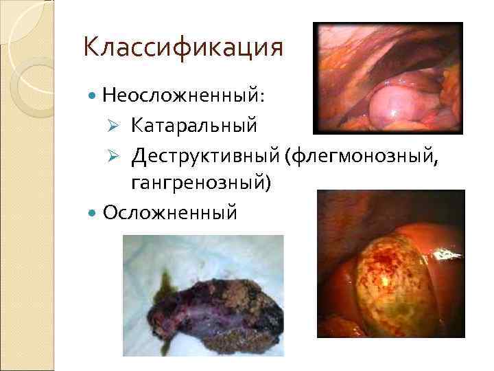 Классификация Неосложненный: Катаральный Ø Деструктивный (флегмонозный, гангренозный) Осложненный Ø 