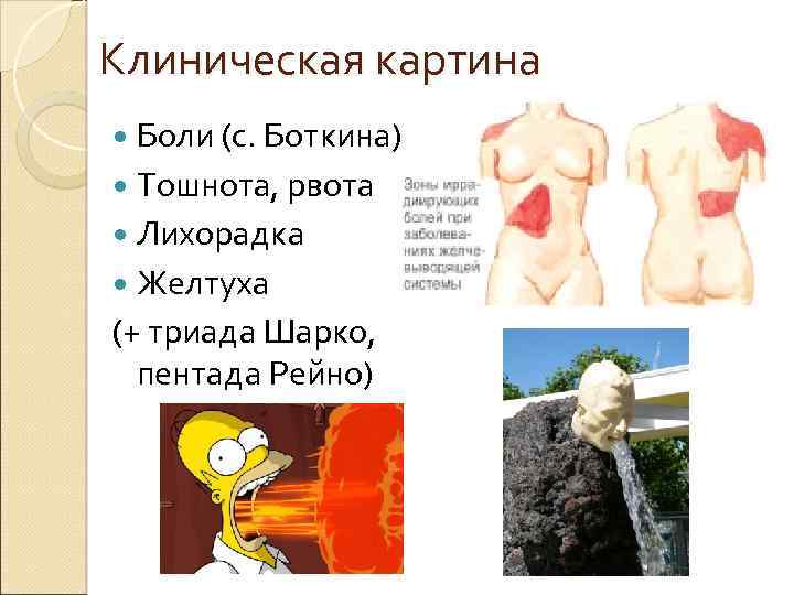 Клиническая картина Боли (с. Боткина) Тошнота, рвота Лихорадка Желтуха (+ триада Шарко, пентада Рейно)