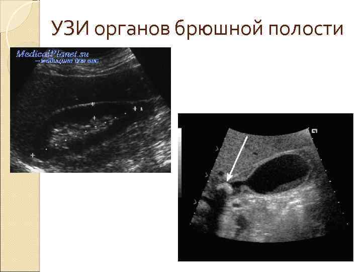 Узи органов брюшной полости картинка