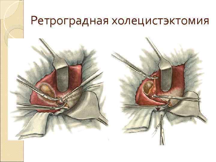 Ретроградная холецистэктомия 