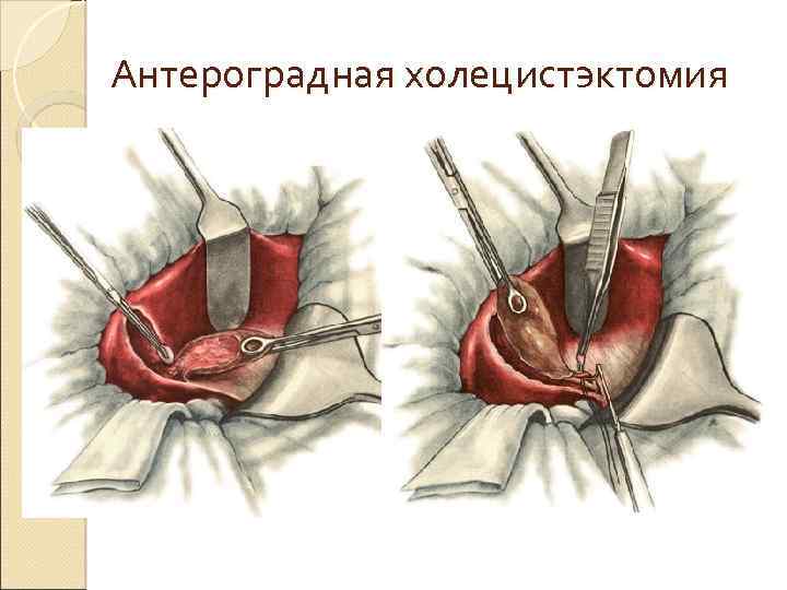 Антероградная холецистэктомия 