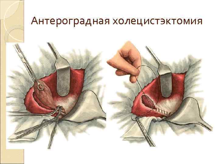 Хронический холецистит картинки