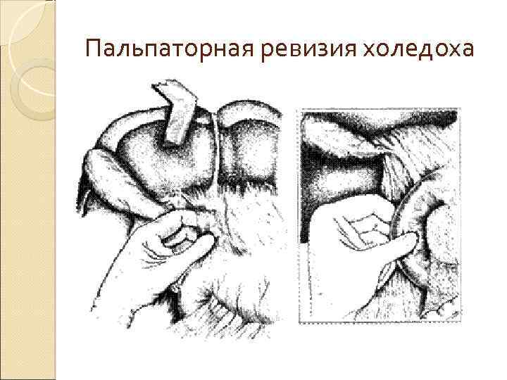 Пальпаторная ревизия холедоха 