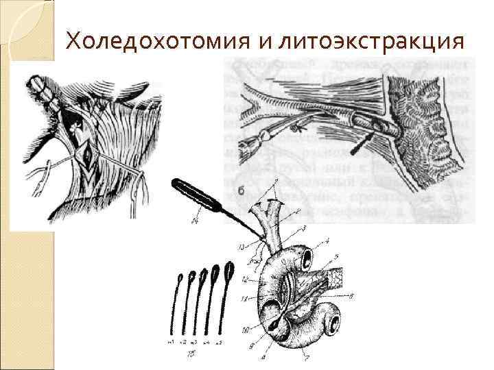 Холедохотомия и литоэкстракция 