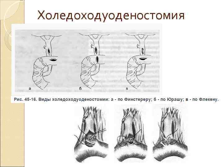 Холедоходуоденостомия 