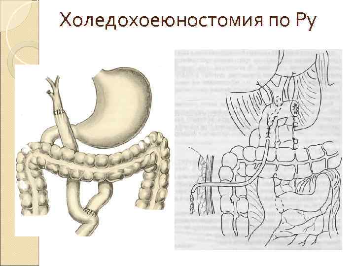 Анастомоз по ру схема