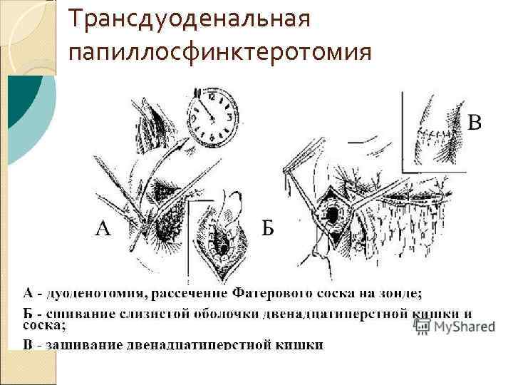 Трансдуоденальная папиллосфинктеротомия 