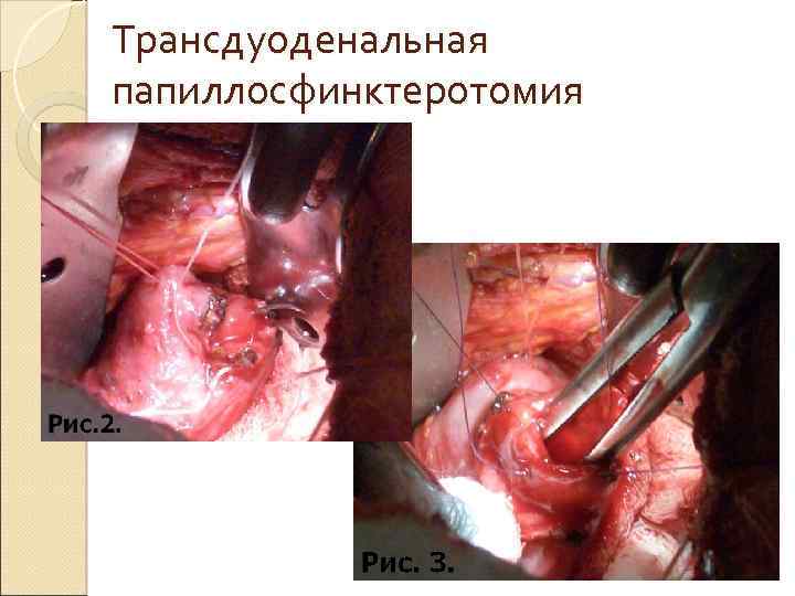 Трансдуоденальная папиллосфинктеротомия 