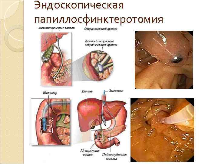 Эндоскопическая папиллосфинктеротомия 