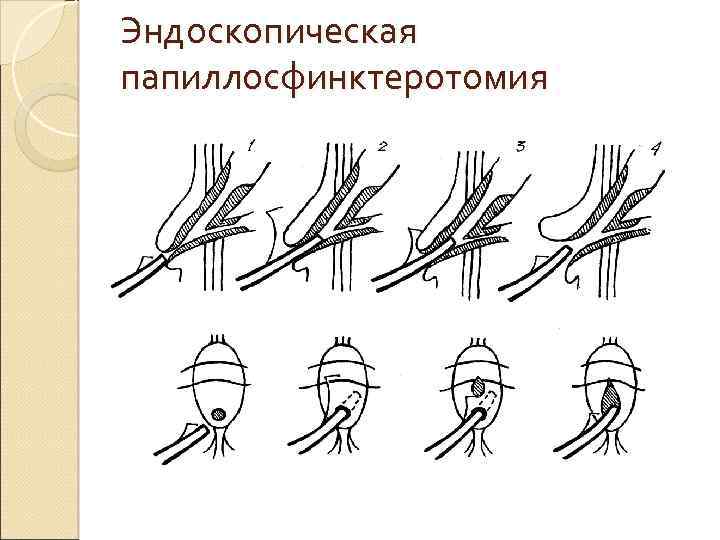 Эндоскопическая папиллосфинктеротомия 