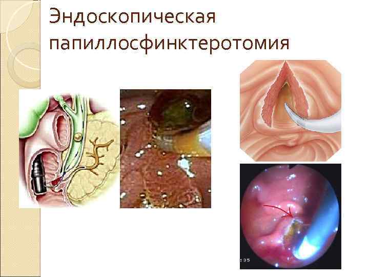 Эндоскопическая папиллосфинктеротомия 