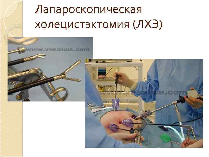 Лапароскопическая холецистэктомия (ЛХЭ) 