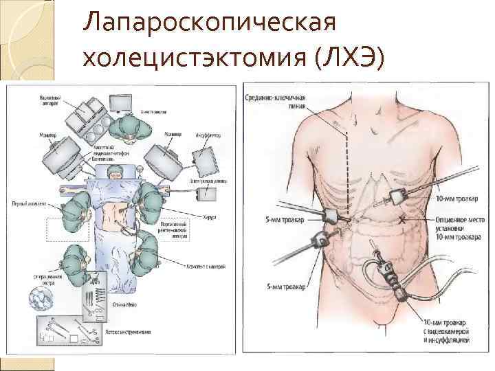 Операция по удалению желчного пузыря анализы