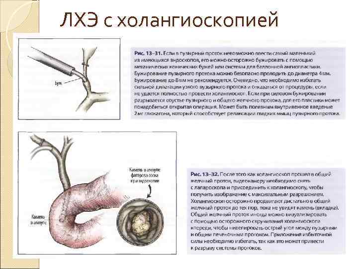 ЛХЭ с холангиоскопией 