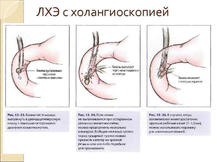 ЛХЭ с холангиоскопией 
