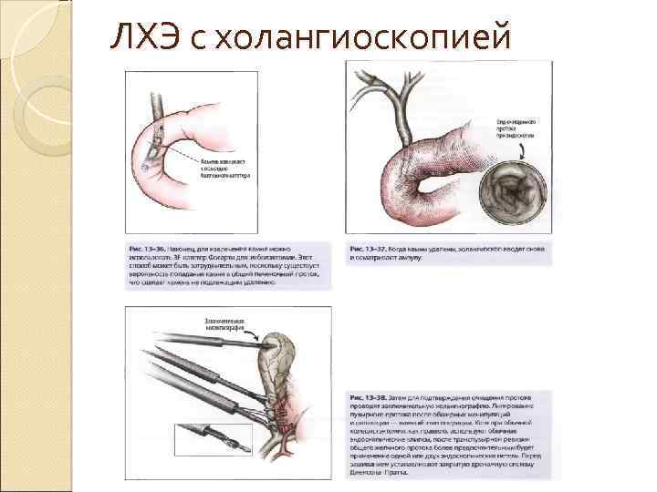 ЛХЭ с холангиоскопией 