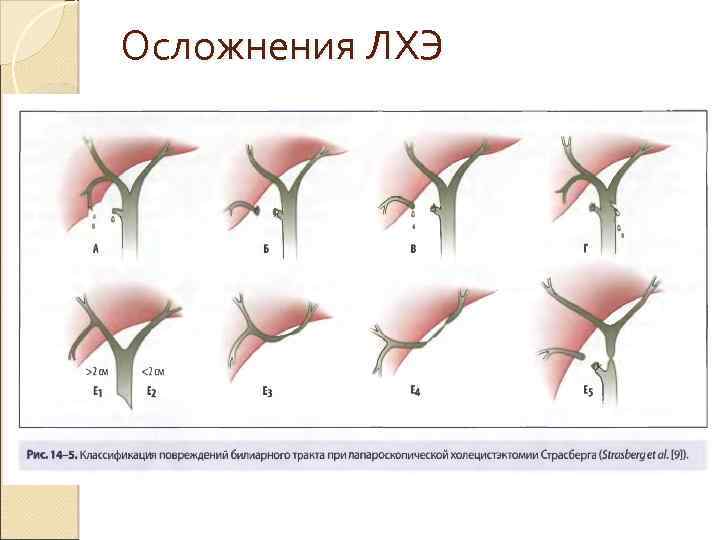 Послеоперационный период после холецистэктомии. Холецистэктомия операция. Лапароскопическая холецистэктомия этапы. Показания к традиционной холецистэктомия.