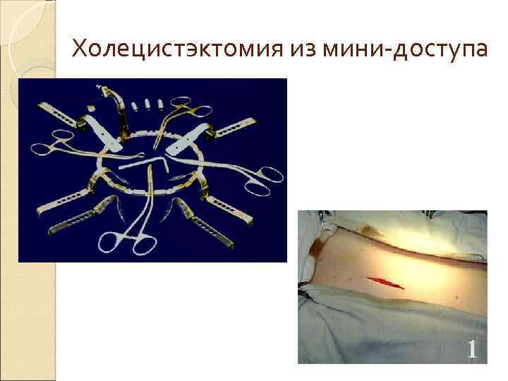 Холецистэктомия из мини-доступа 