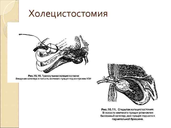 Холецистостомия 