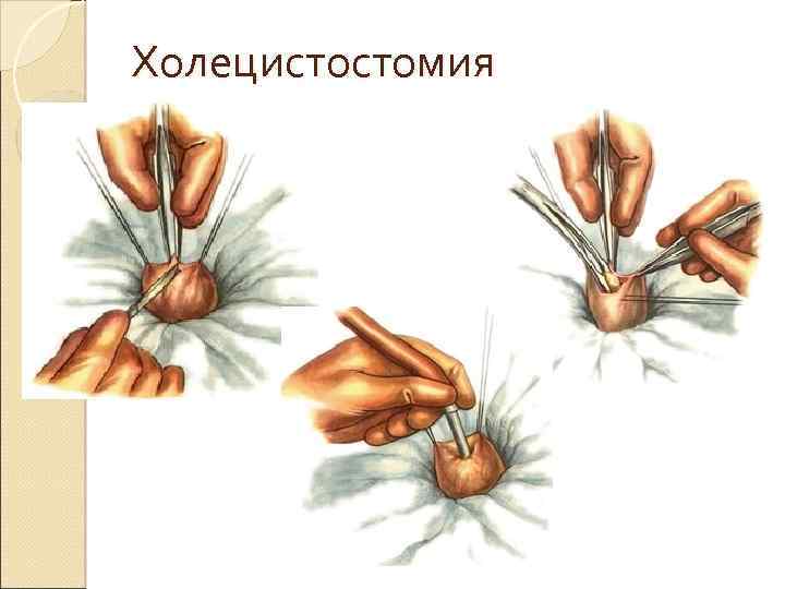 Холецистостомия 