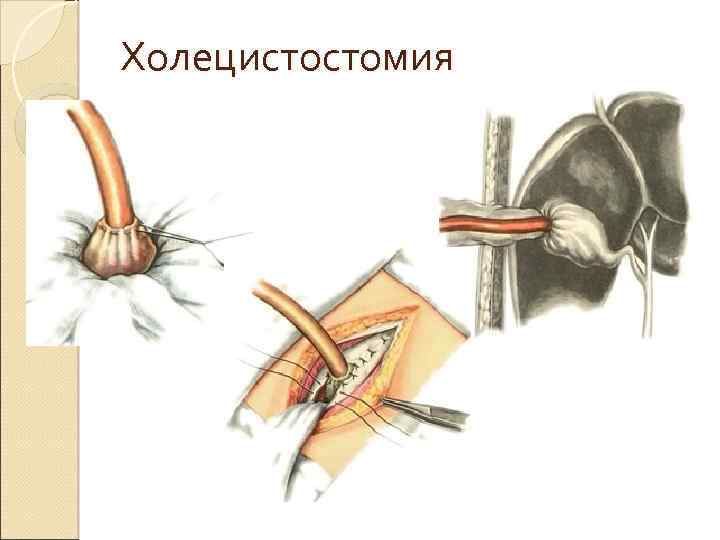 Холецистостомия 