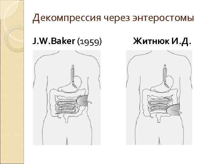 Декомпрессия через энтеростомы J. W. Baker (1959) Житнюк И. Д. 