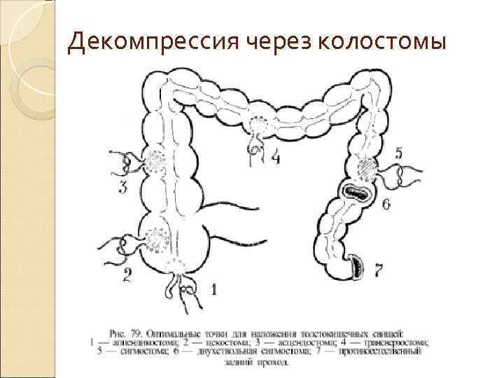 Схема изменений толстой кишки при болезни гиршпрунга