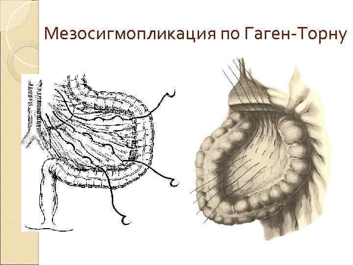 Торна тавышы. Гаген Торну это мезосигмопликация. Мезосигмопликация по методу Гаген-Торна. Мезосигмопликация по Гаген-Торну при завороте сигмовидной кишки.