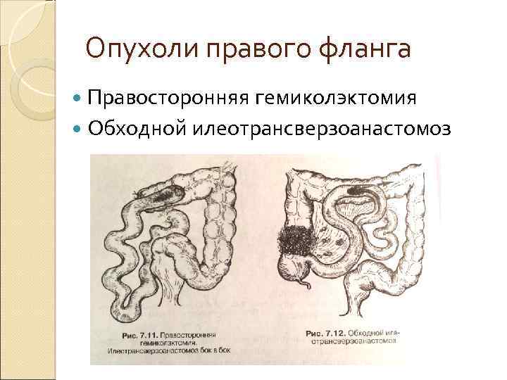 Кишечная непроходимость у детей карта вызова