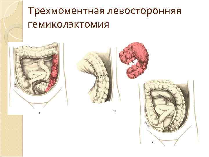 Трехмоментная левосторонняя гемиколэктомия 