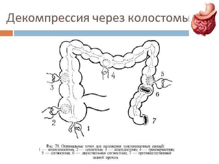 Декомпрессия через колостомы 