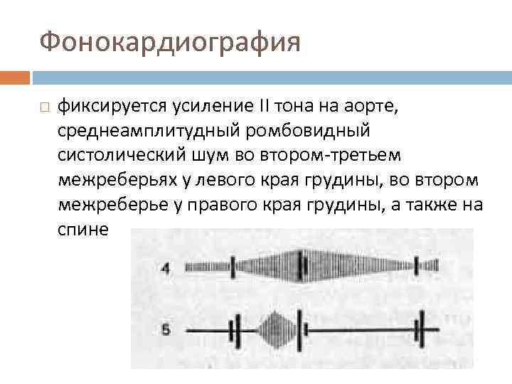 Фонокардиография фиксируется усиление II тона на аорте, среднеамплитудный ромбовидный систолический шум во втором-третьем межреберьях