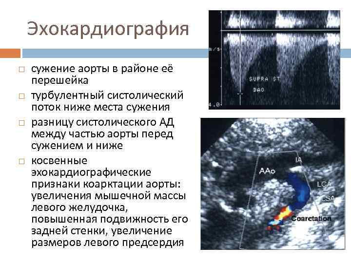 Эхокардиография сужение аорты в районе её перешейка турбулентный систолический поток ниже места сужения разницу