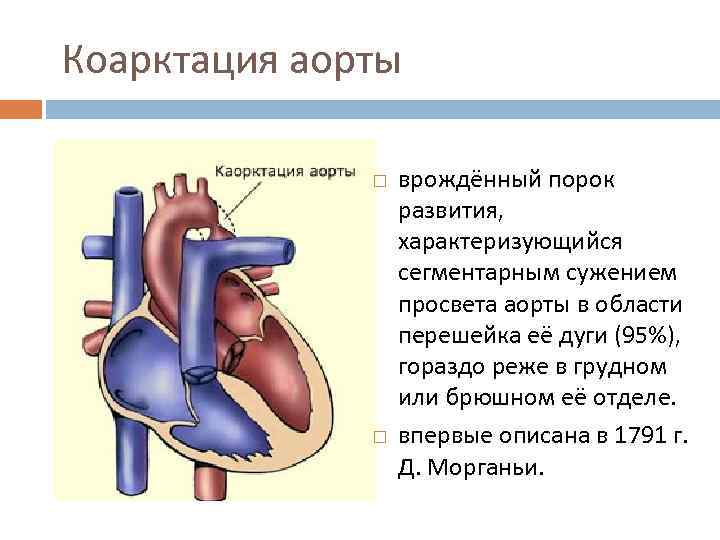 Коарктация аорты фото